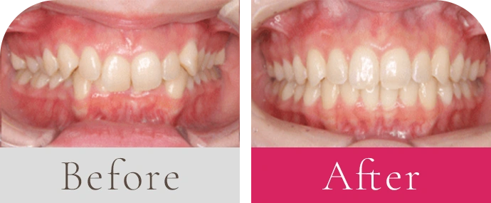 過蓋咬合 前歯のガタガタビフォーアフター