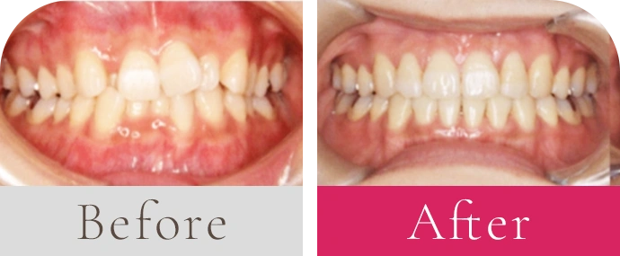 前歯のガタガタビフォーアフター