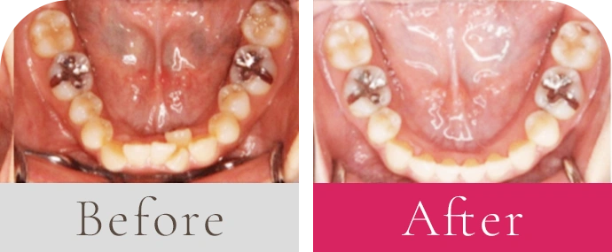 前歯のガタガタビフォーアフター