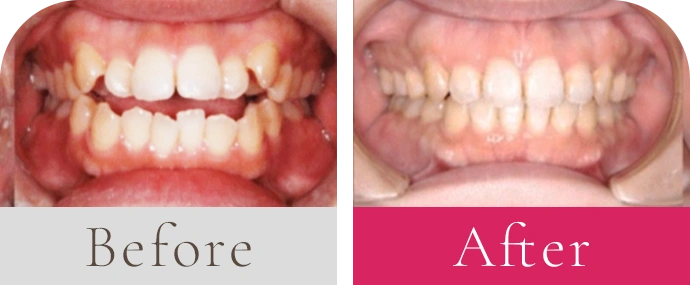 奥歯で噛んでも前歯が噛み合わない（開咬）、前歯のガタガタビフォーアフター