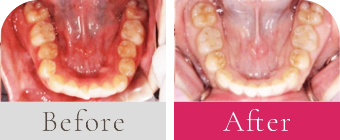 奥歯で噛んでも前歯が噛み合わない（開咬）、前歯のガタガタビフォーアフター