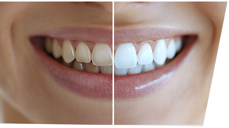 矯正と同時にホワイトニングも可能