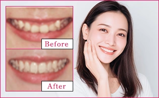 ガミースマイル